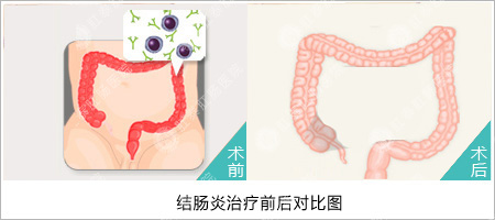 早期直肠炎的症状是什么？