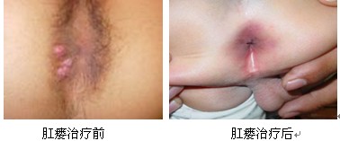 肛瘘形成的原因