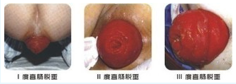 直肠脱垂