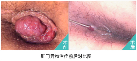 肛门周围长疙瘩怎么回事