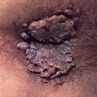 如何治疗肛门湿疹好？