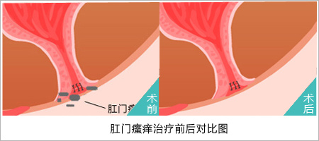 肛门老是瘙痒该怎么办？