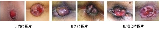 太原肛肠医院