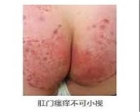 肛门瘙痒的危害