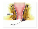 女性易患外痔的原因